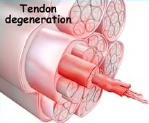 tendon degeneration